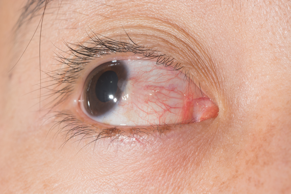 What Is A Pterygium And Why Is It Called "Surfer's Eye"? - OPTX Rhode ...